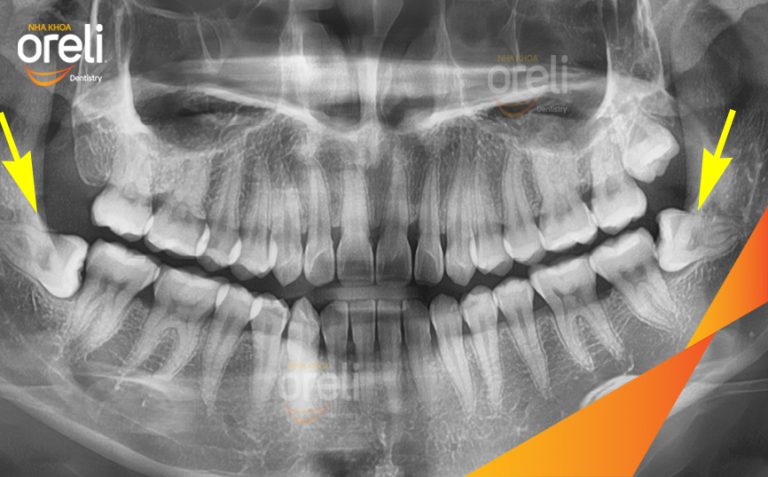 Ca Nhổ 2 Chiếc Răng Khôn Mọc Lệch Tại Nha khoa Oreli