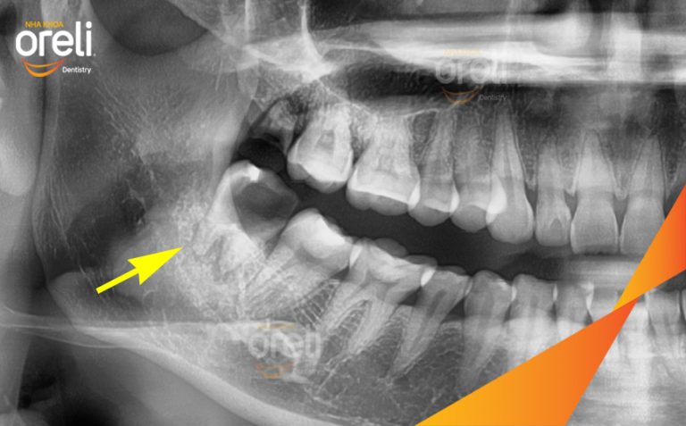 Ca Nhổ Răng Khôn – Hình Ảnh Trước Và Sau Khi Nhổ răng Khôn Tại Oreli