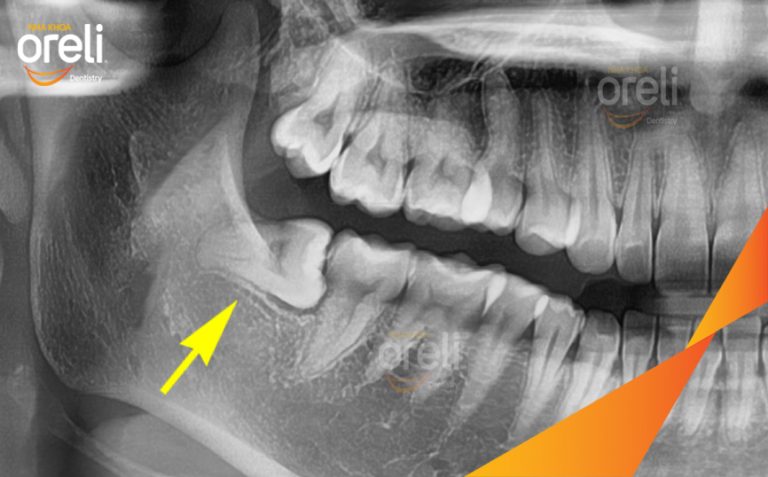 Ca Nhổ Răng Khôn Mọc Lệch | Nha khoa Oreli