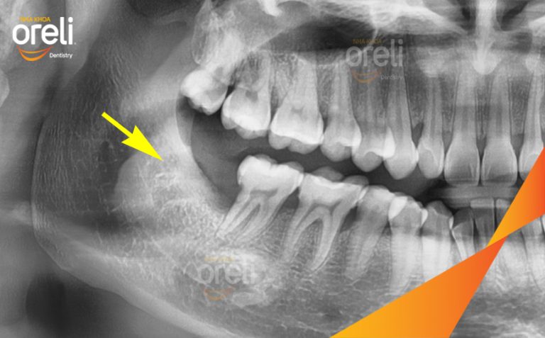 Ca nhổ răng khôn hàm dưới mọc lệch – Case thực tế tại Nha khoa Oreli