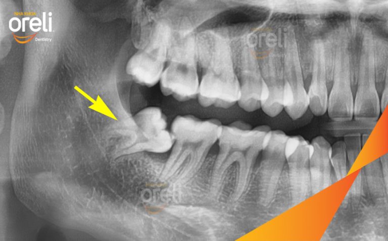 Ca nhổ răng khôn hàm dưới mọc lệch – Case thực tế tại Nha khoa Oreli