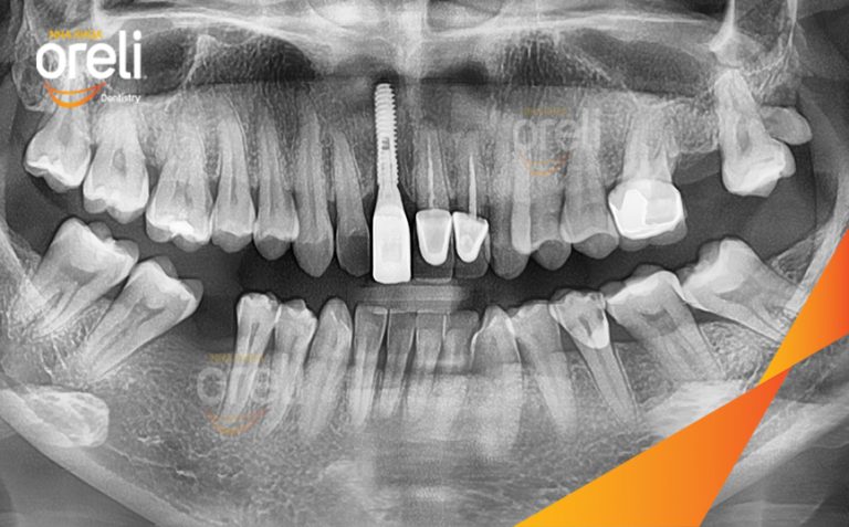 Ca Cấy Implant Phục Hồi Răng Cửa Hàm Trên Và Răng Cối Lớn Hàm Dưới Tại Oreli