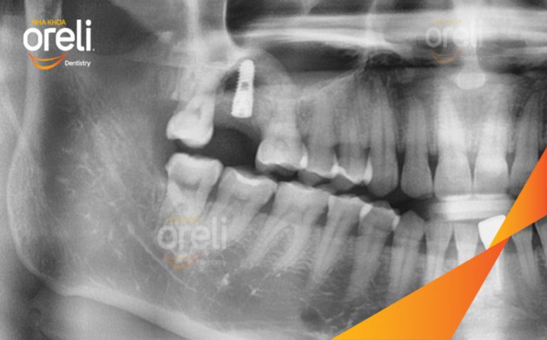 Phục Hồi Răng Mất Hàm Trên Bằng Implant l Nha Khoa Oreli