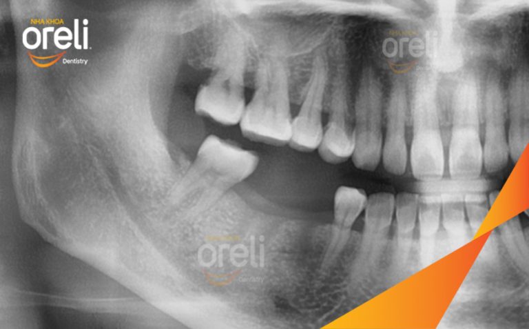Ca Phục Hồi Răng Mất Hàm Dưới – Case thực tế tại Nha khoa Oreli