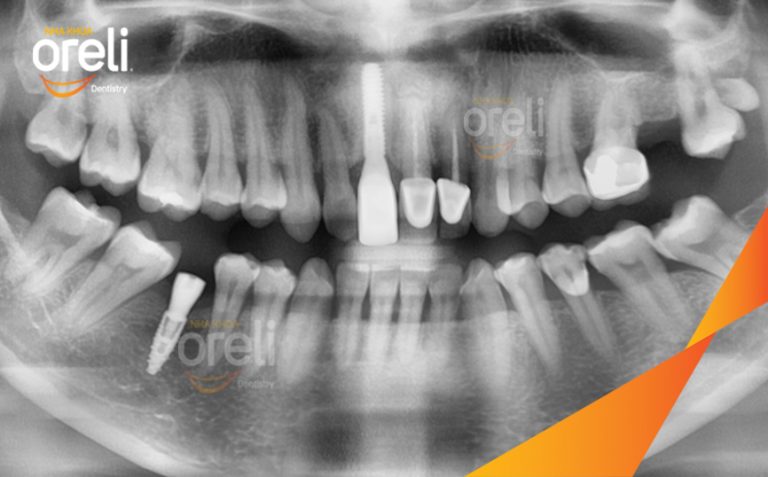 Ca Cấy Implant Phục Hồi Răng Cửa Hàm Trên Và Răng Cối Lớn Hàm Dưới Tại Oreli