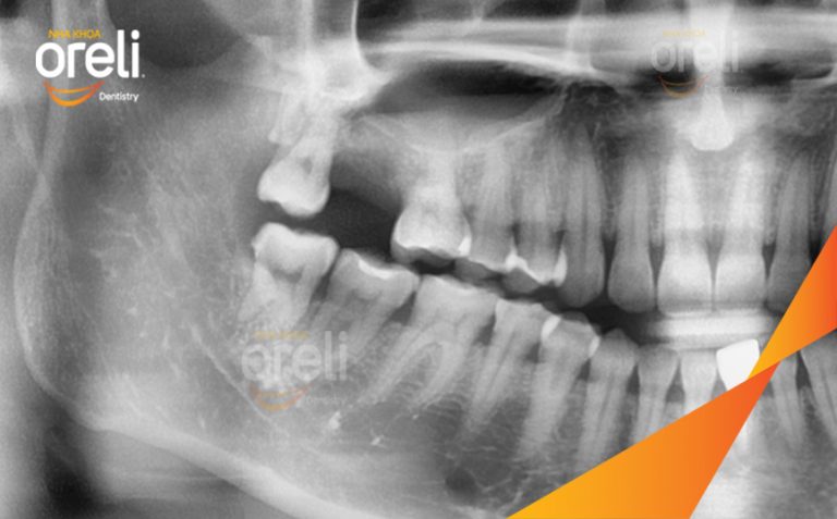 Phục Hồi Răng Mất Hàm Trên Bằng Implant l Nha Khoa Oreli