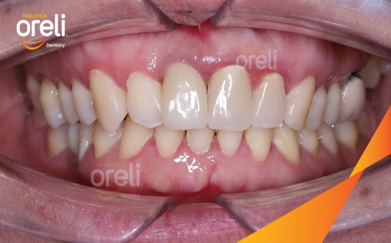 Ca Cấy Implant Phục Hồi Răng Cửa Hàm Trên Và Răng Cối Lớn Hàm Dưới Tại Oreli