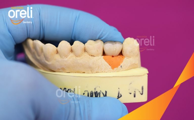Phục Hồi Răng Mất Hàm Trên Bằng Implant l Nha Khoa Oreli