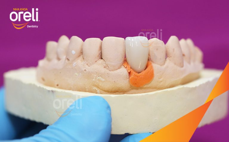 Ca Cấy Implant Phục Hồi Răng Cửa Hàm Trên Và Răng Cối Lớn Hàm Dưới Tại Oreli