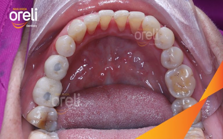 Ca Phục Hồi Răng Mất Hàm Dưới – Case thực tế tại Nha khoa Oreli