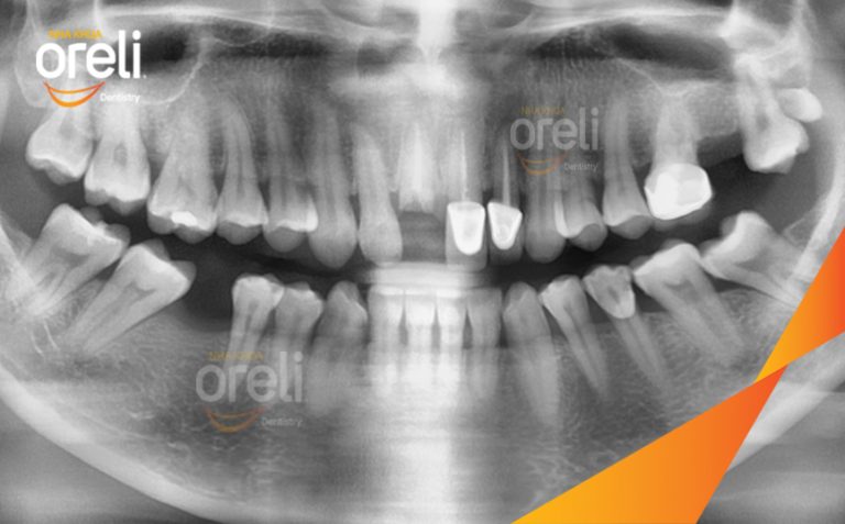 Ca Cấy Implant Phục Hồi Răng Cửa Hàm Trên Và Răng Cối Lớn Hàm Dưới Tại Oreli