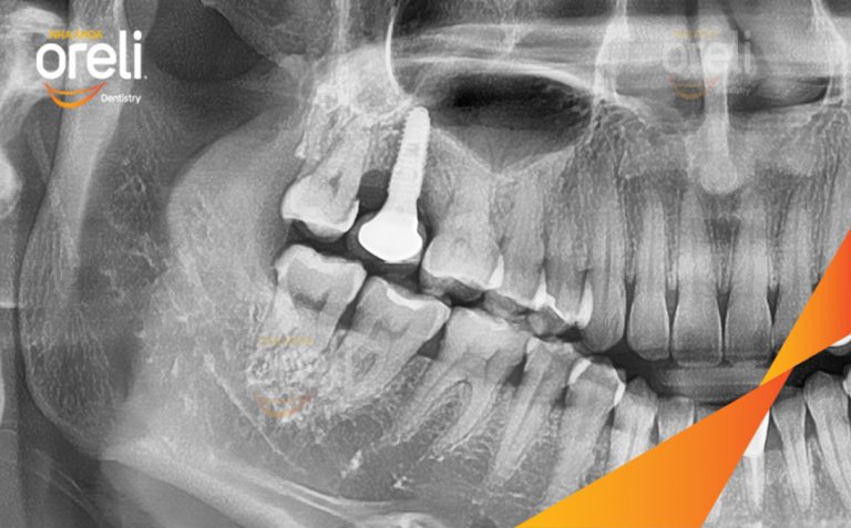 Phục Hồi Răng Mất Hàm Trên Bằng Implant l Nha Khoa Oreli