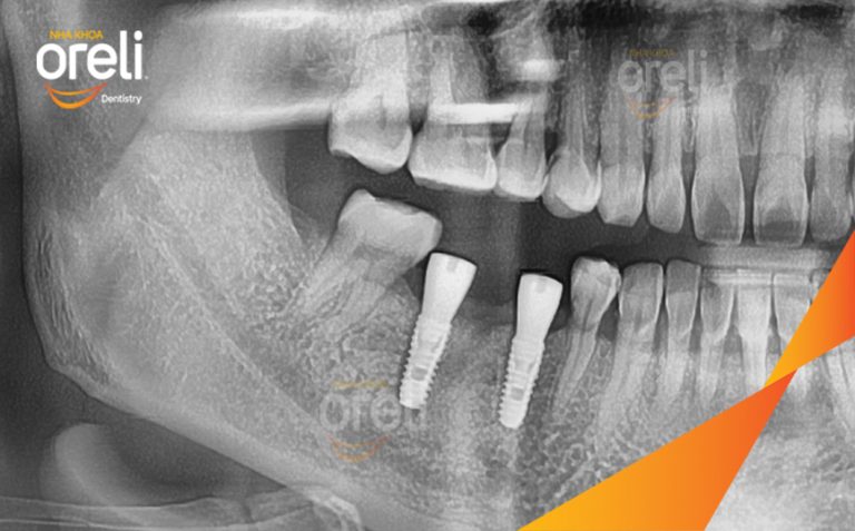 Ca Phục Hồi Răng Mất Hàm Dưới – Case thực tế tại Nha khoa Oreli