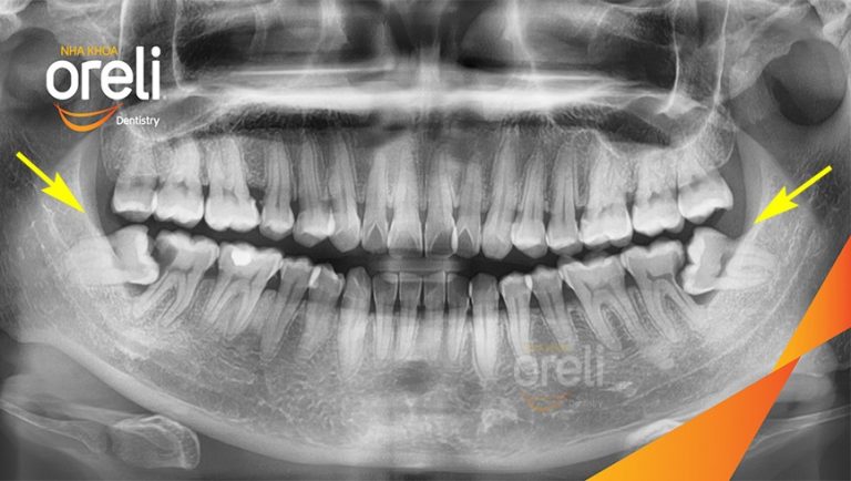 Nhổ 2 Răng Khôn Cùng Lúc Có Được Không?