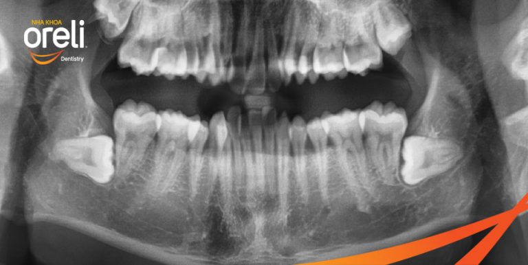 Răng khôn mọc ngang có nguy hiểm không? Khi nào nên nhổ?