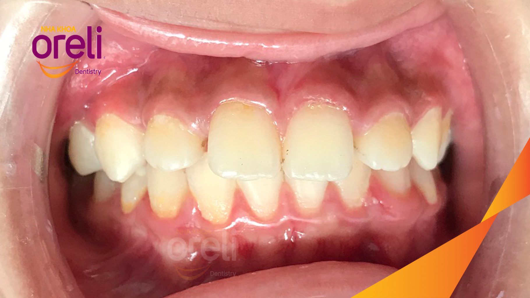 Quá trình Điều trị chỉnh nha bằng mắc cài, sắp xếp lại vị trí các răng và kiểm soát khoảng thưa. trong 2 năm tại Nha khoa Oreli