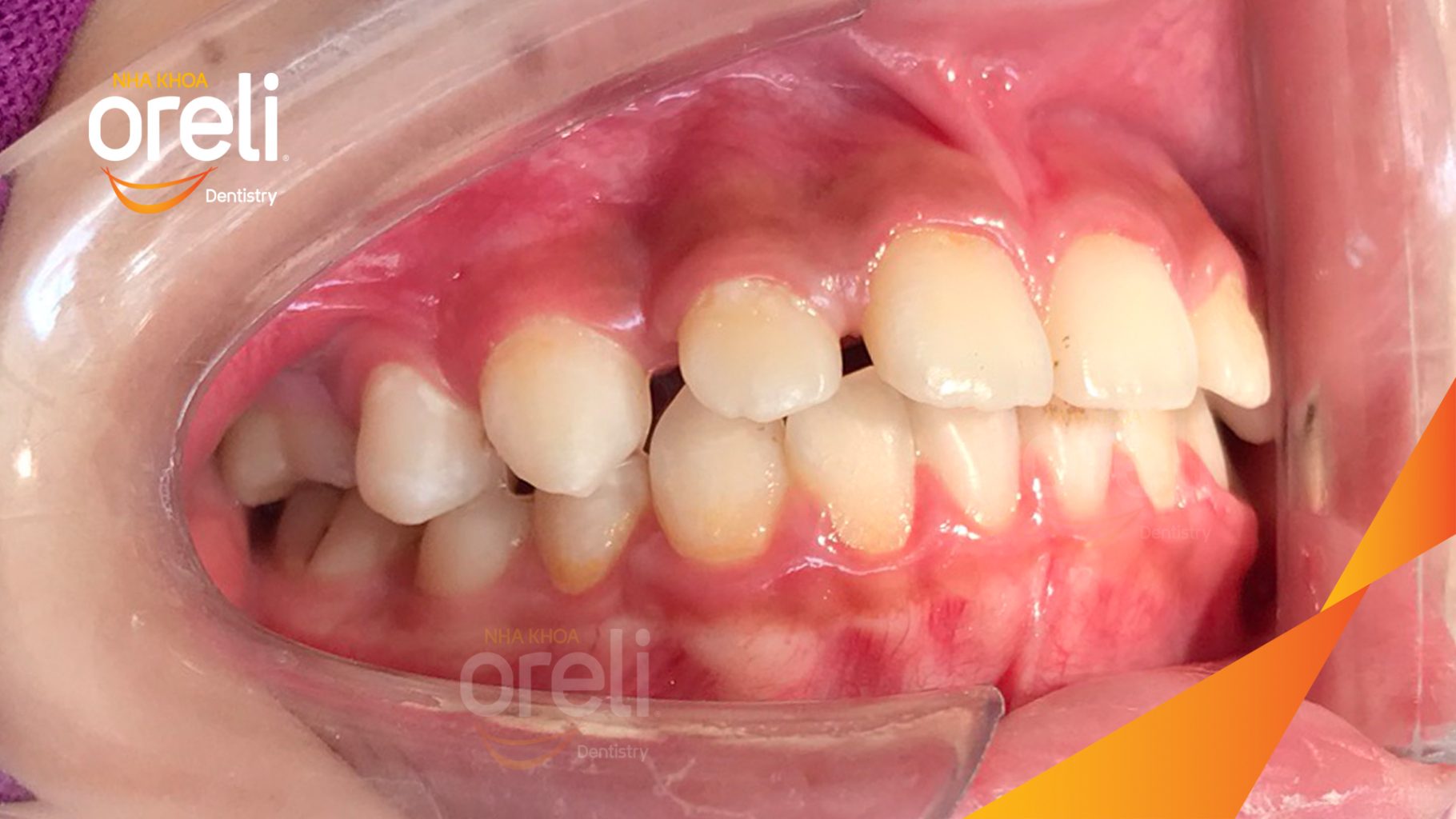 Trước điều trị: Khe thưa răng cửa, răng sắp xếp chưa đều và khớp cắn cần được chỉnh nha. tại Nha khoa Oreli