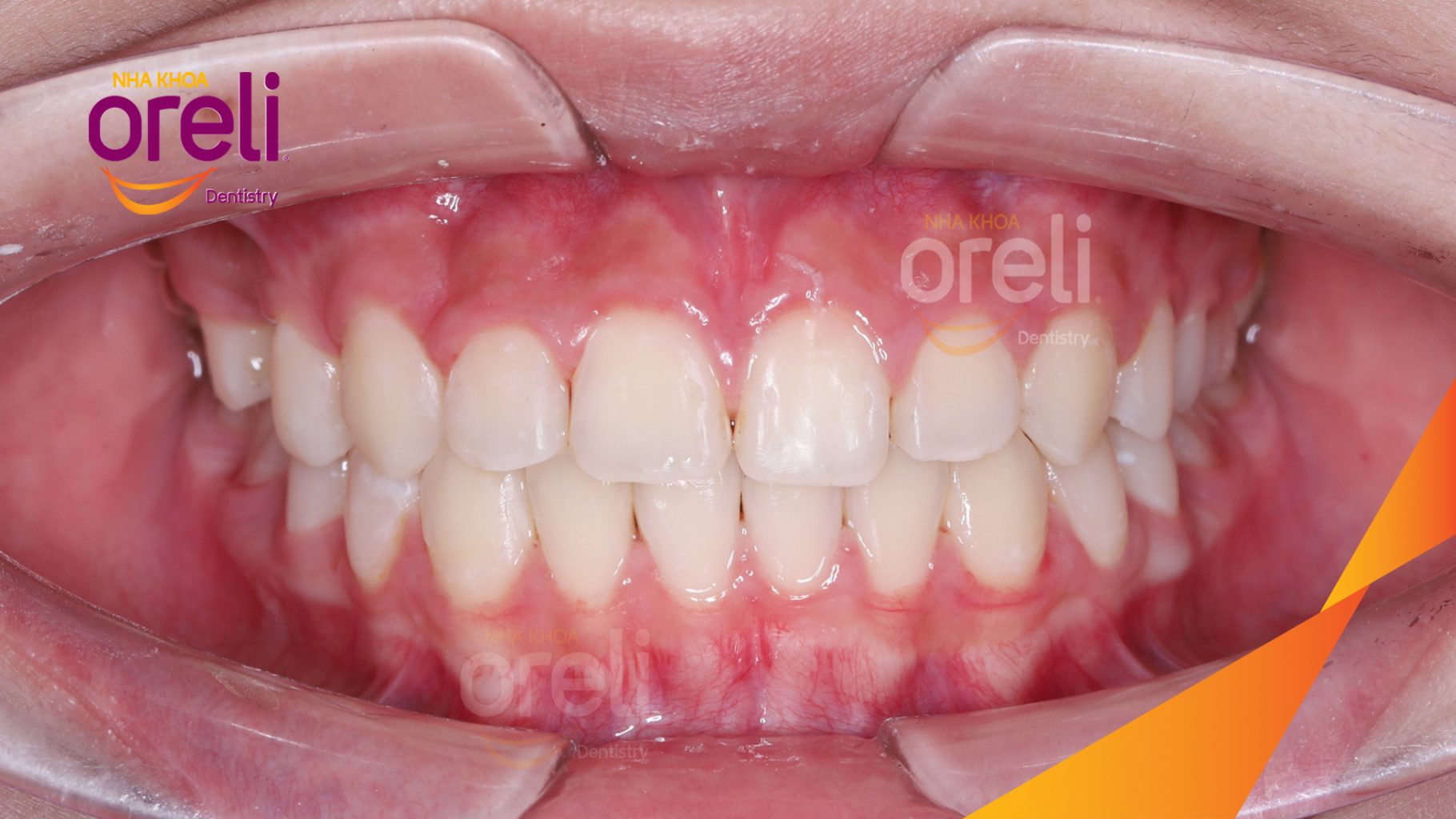 Thực hiện Điều trị chỉnh nha bằng mắc cài, sắp xếp lại vị trí các răng và kiểm soát khoảng thưa. kéo dài 2 năm tại Nha khoa Oreli