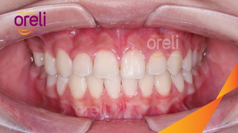 Niềng khe thưa răng cửa: Hình ảnh trước và sau khi tháo mắc cài tại Oreli
