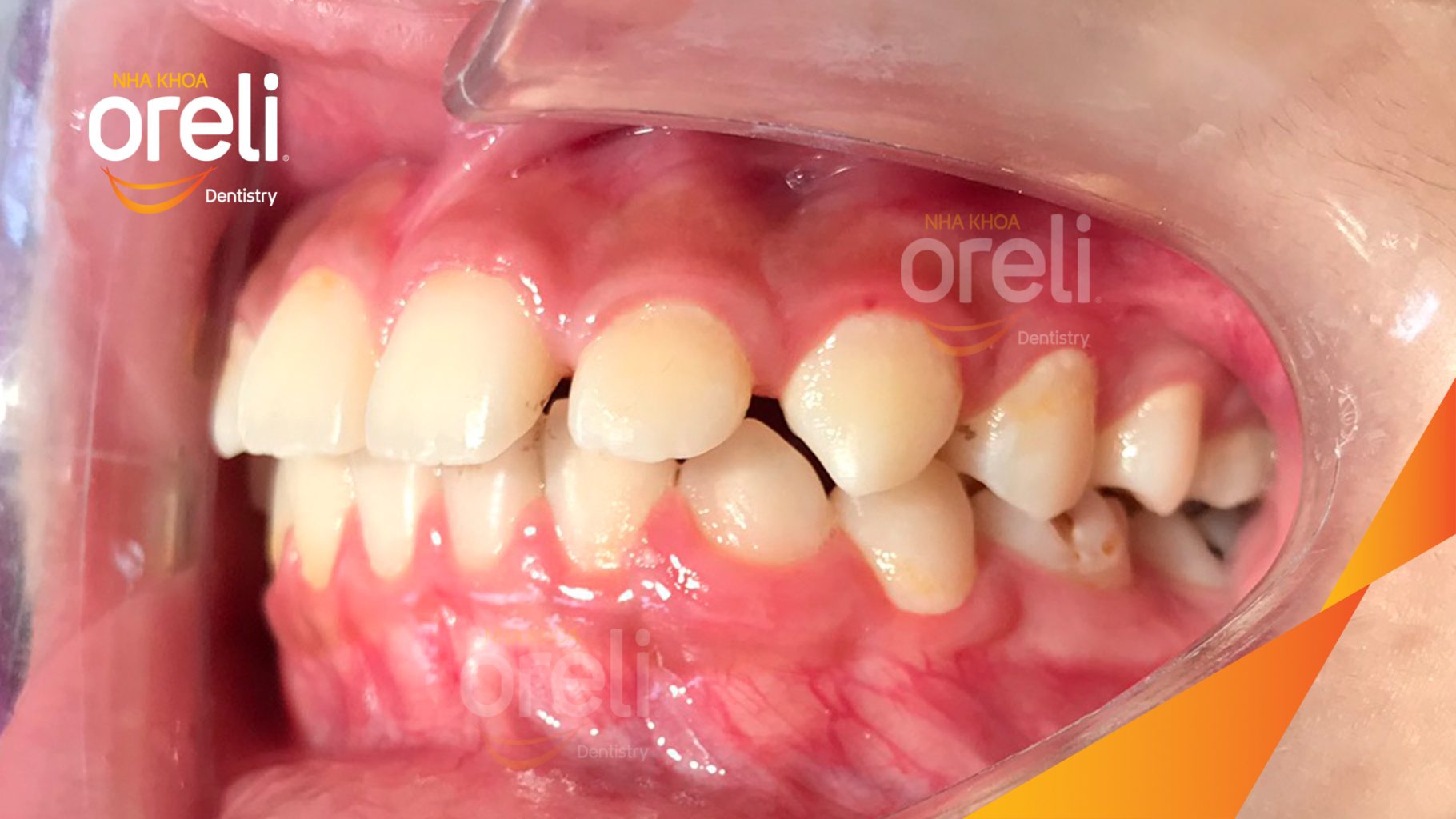 Khe thưa răng cửa, răng sắp xếp chưa đều và khớp cắn cần được chỉnh nha. trước khi điều trị tại Nha khoa Oreli