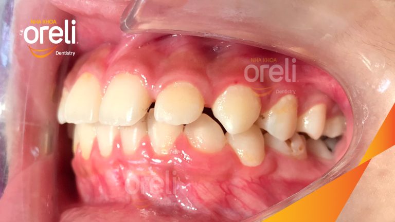Niềng khe thưa răng cửa: Hình ảnh trước và sau khi tháo mắc cài tại Oreli
