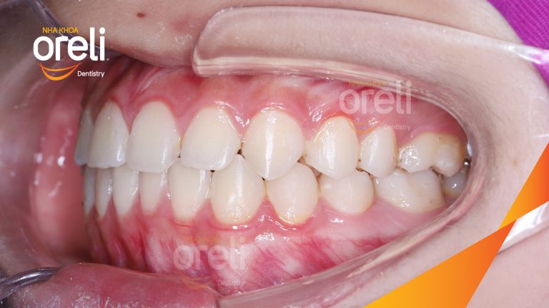 Niềng khe thưa răng cửa: Hình ảnh trước và sau khi tháo mắc cài tại Oreli