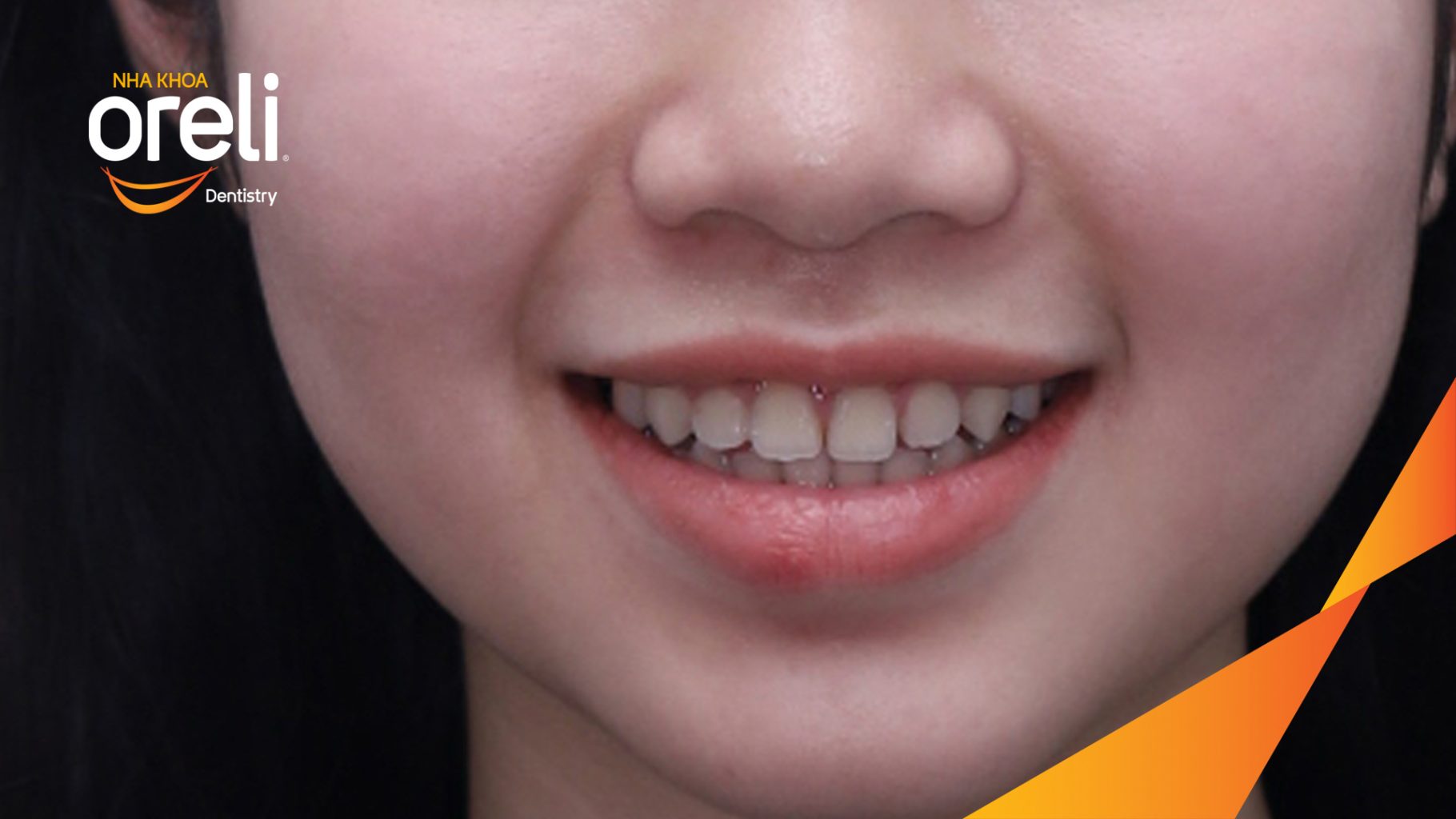 Khe thưa răng cửa, răng sắp xếp chưa đều và khớp cắn cần được chỉnh nha. trước khi điều trị tại Nha khoa Oreli