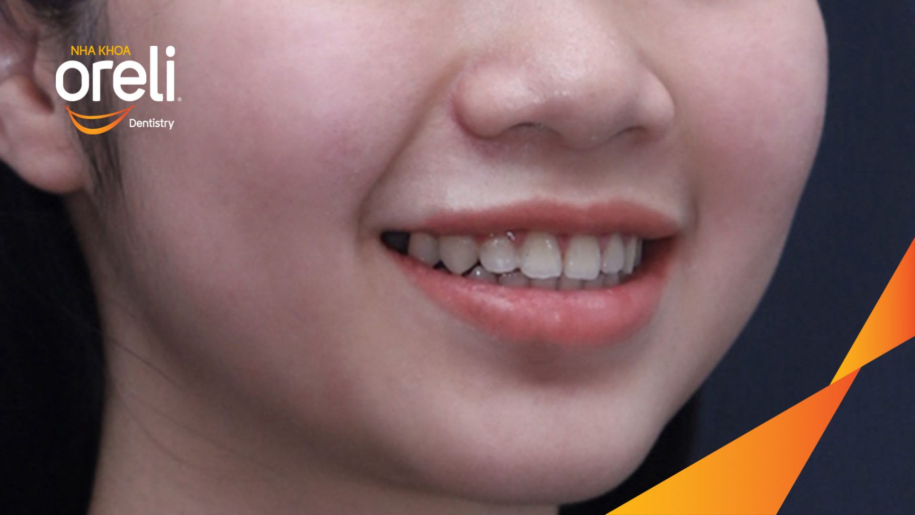 Quá trình Điều trị chỉnh nha bằng mắc cài, sắp xếp lại vị trí các răng và kiểm soát khoảng thưa. trong 2 năm tại Nha khoa Oreli