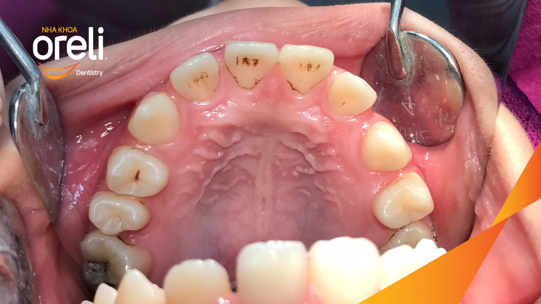 Kết quả sau 2 năm: Hoàn tất điều trị và tháo mắc cài. tại Nha khoa Oreli