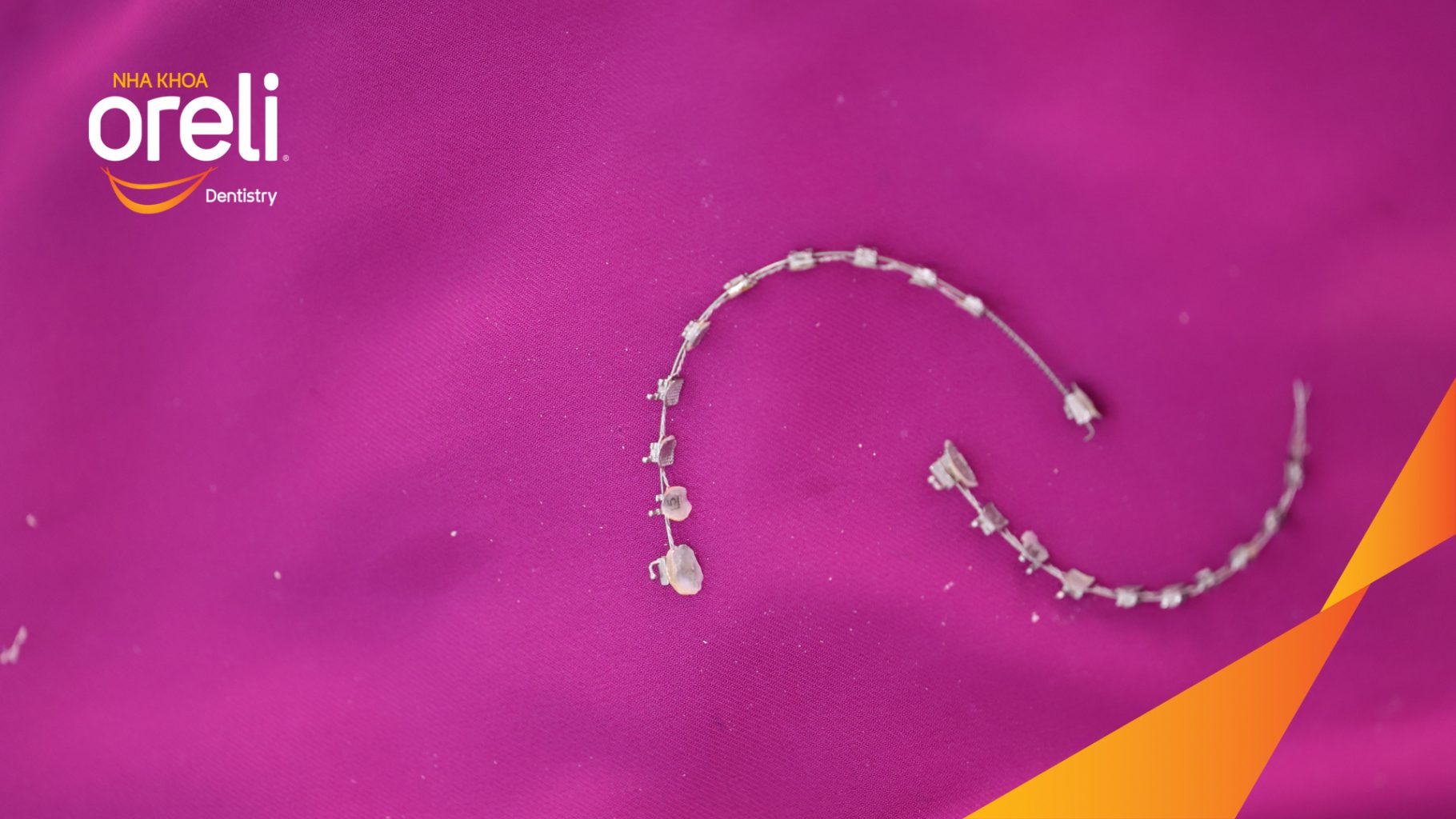 Kết quả đạt được sau 2 năm - Hoàn tất điều trị và tháo mắc cài. tại Nha khoa Oreli