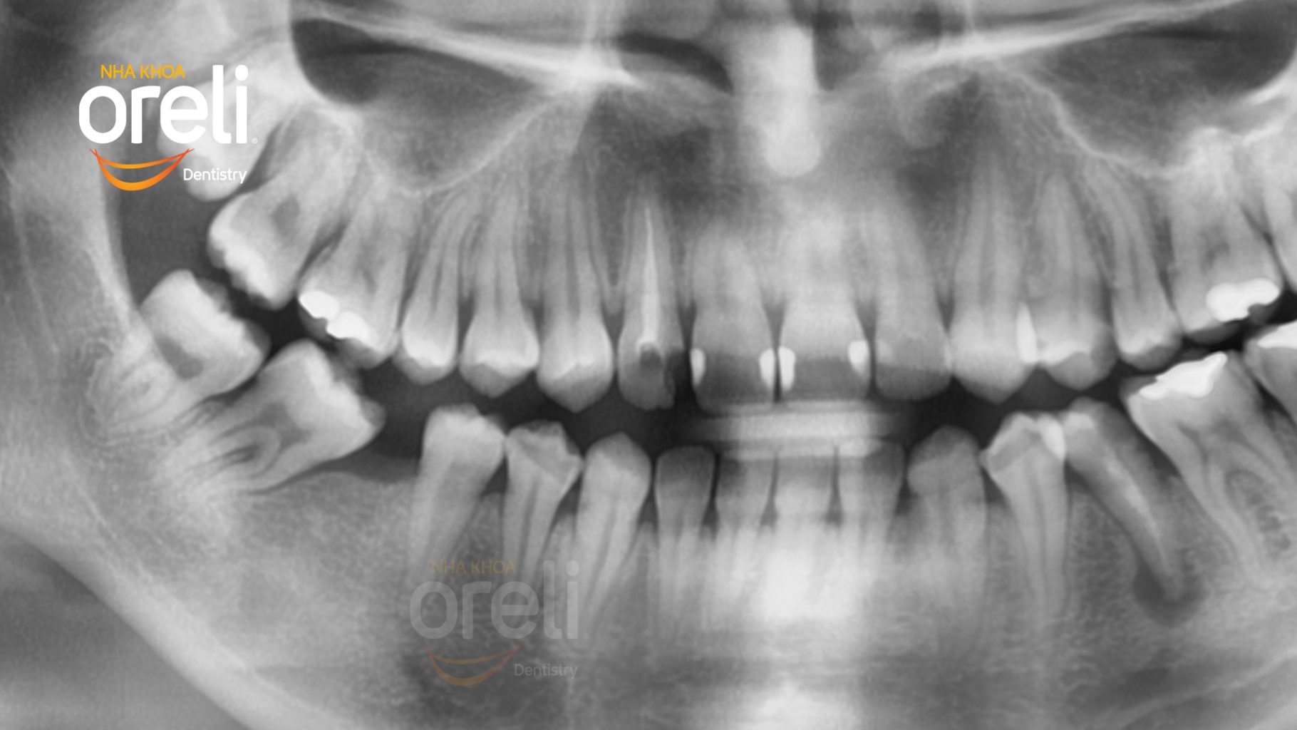 Quá trình Thay vì chỉ phục hồi khoảng mất răng, kế hoạch chỉnh nha được xây dựng theo hướng di gần các răng phía sau, từng bước đưa răng 7 và 8 về phía trước. trong 2 năm tại Nha khoa Oreli