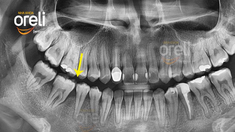 Di gần răng 78 hàm dưới – Điều trị khoảng mất răng bằng chỉnh nha tại Nha khoa Oreli