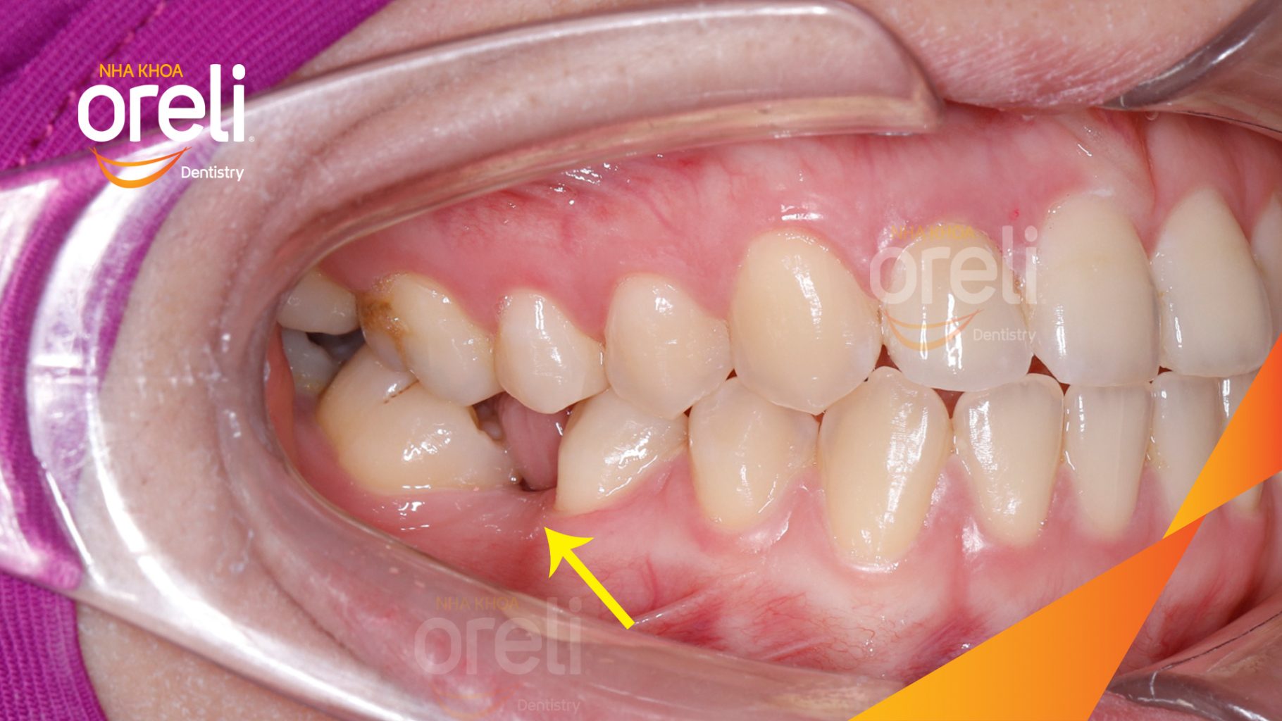 Kết quả sau 2 năm: Sau quá trình điều trị, khoảng mất răng được thu hẹp khít sát, các răng vùng hàm dưới được đưa về vị trí mới và khớp cắn được điều chỉnh lại. tại Nha khoa Oreli