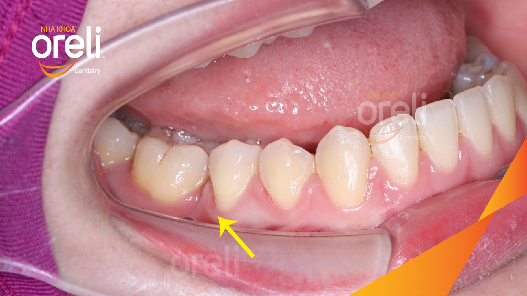 Kết quả đạt được sau 2 năm - Sau quá trình điều trị, khoảng mất răng được thu hẹp khít sát, các răng vùng hàm dưới được đưa về vị trí mới và khớp cắn được điều chỉnh lại. tại Nha khoa Oreli