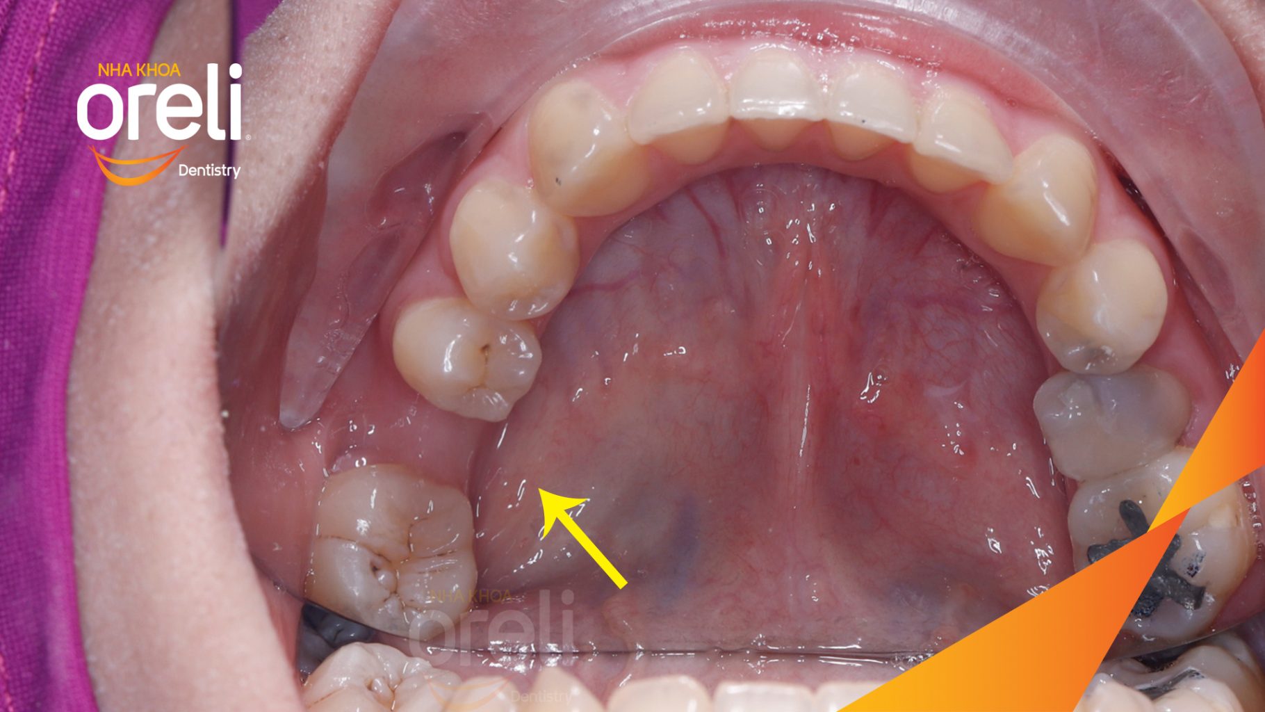 Trước điều trị: Trên phim X-quang, vùng răng cối hàm dưới có khoảng mất răng, trong khi răng 7 và răng 8 nằm phía sau. Răng 8 mọc lệch và chưa ở vị trí thuận lợi để tham gia chức năng. tại Nha khoa Oreli