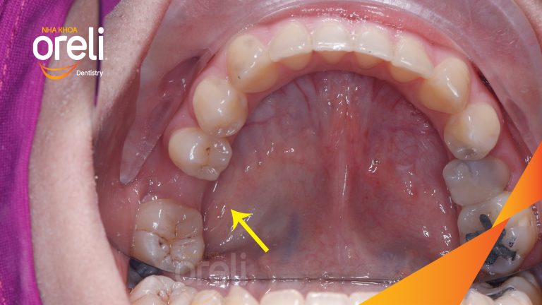 Di gần răng 78 hàm dưới – Điều trị khoảng mất răng bằng chỉnh nha tại Nha khoa Oreli