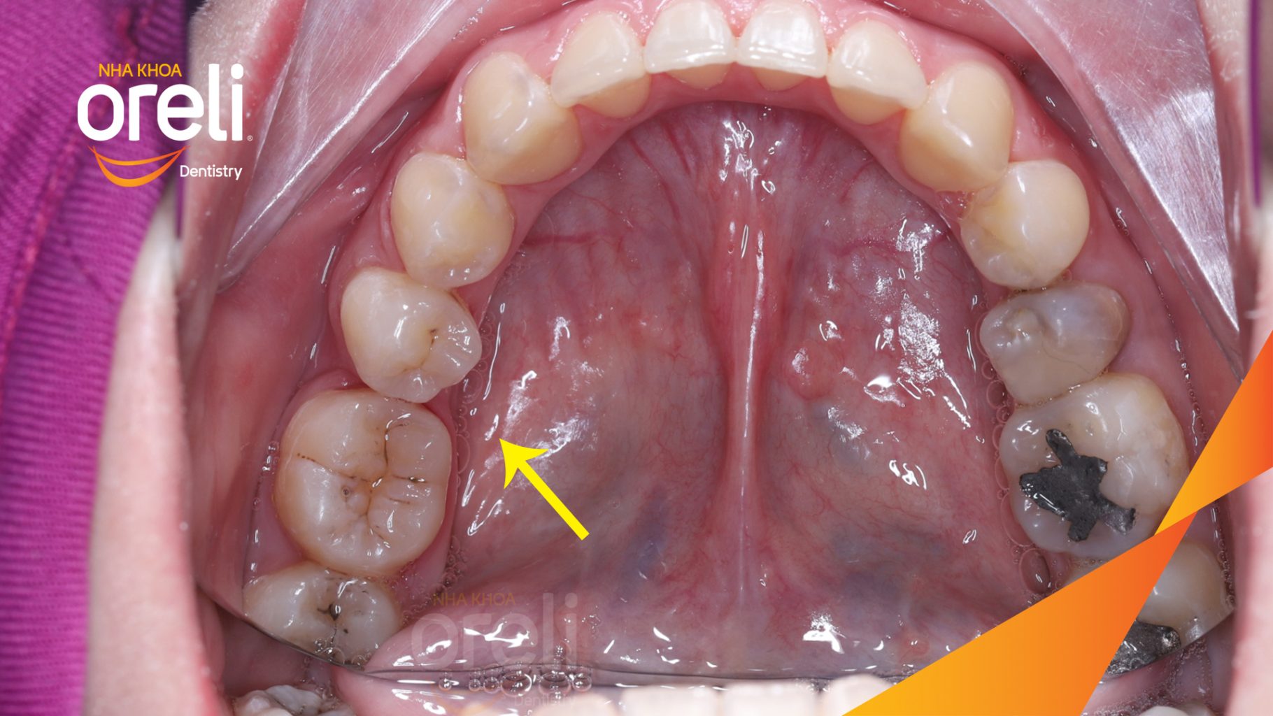 Trên phim X-quang, vùng răng cối hàm dưới có khoảng mất răng, trong khi răng 7 và răng 8 nằm phía sau. Răng 8 mọc lệch và chưa ở vị trí thuận lợi để tham gia chức năng. trước khi điều trị tại Nha khoa Oreli