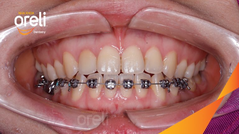 Di gần răng 78 hàm dưới – Điều trị khoảng mất răng bằng chỉnh nha tại Nha khoa Oreli