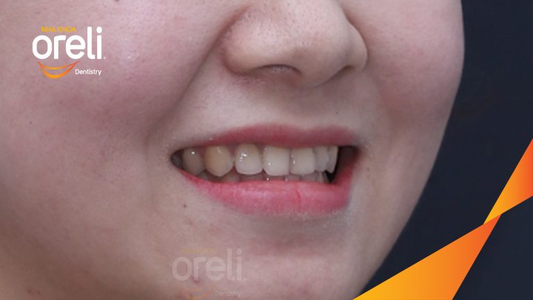 Di gần răng 78 hàm dưới – Điều trị khoảng mất răng bằng chỉnh nha tại Nha khoa Oreli