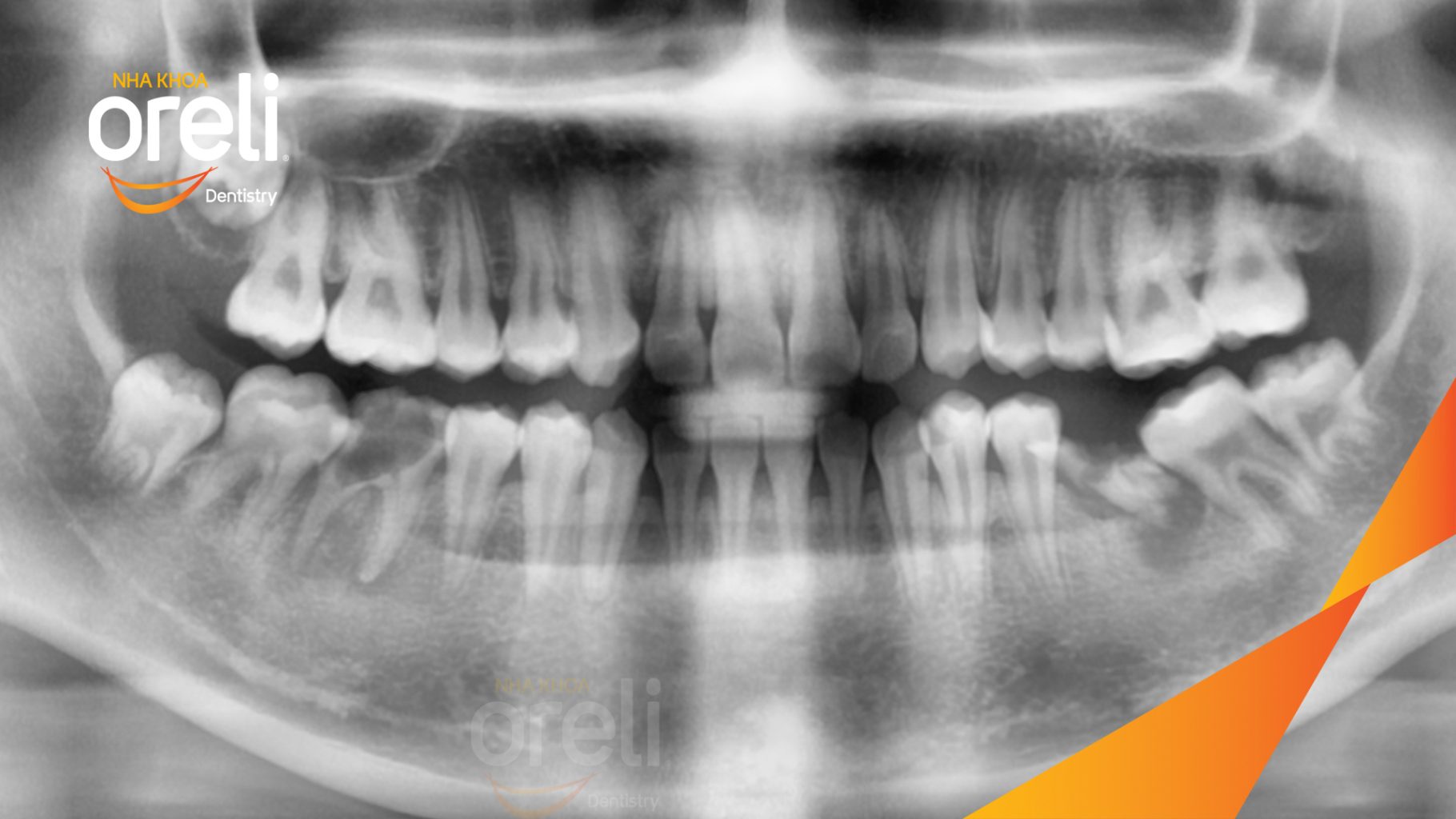 Trước điều trị: Mất răng 36 46 do sâu vỡ  tại Nha khoa Oreli