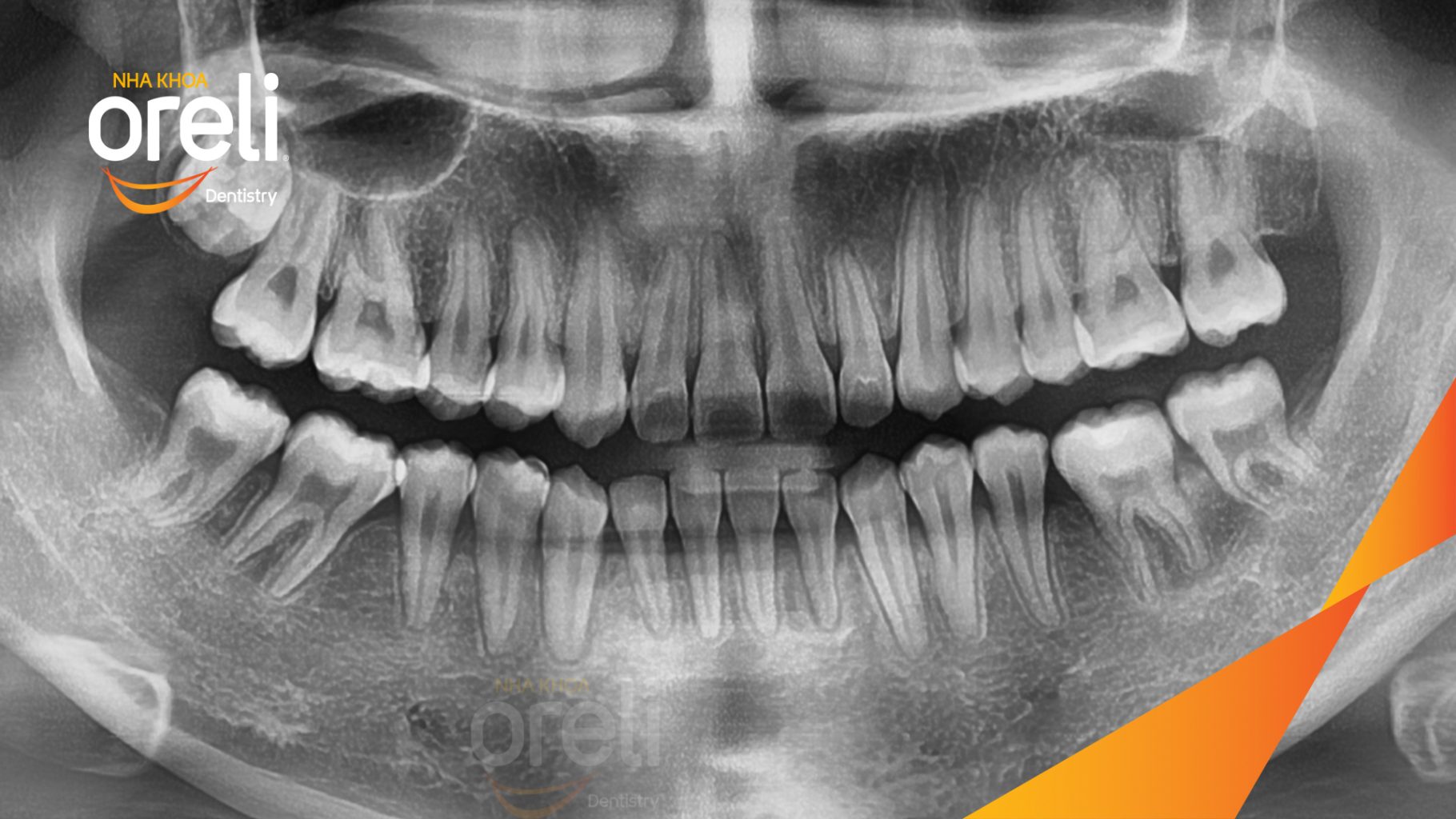 Mất răng 36 46 do sâu vỡ  trước khi điều trị tại Nha khoa Oreli