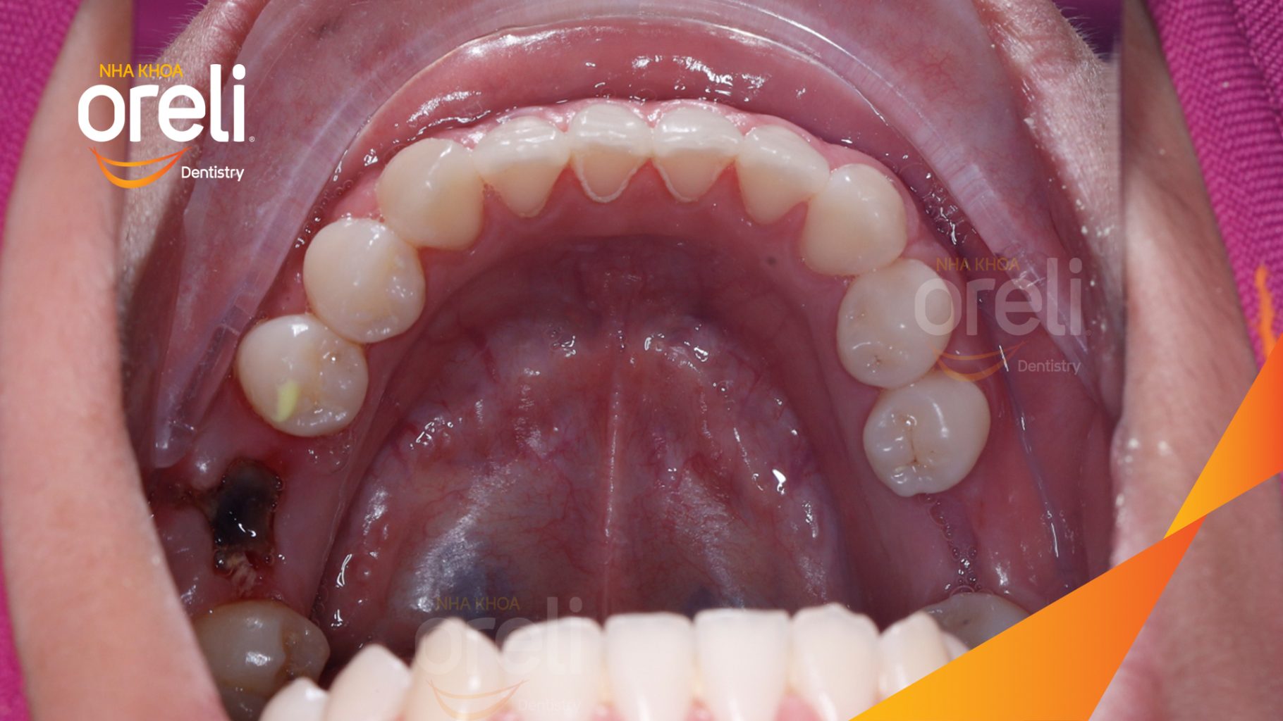 Quá trình Niềng di gần răng 78 hàm dưới thay thế răng 6 mất trong 2 năm tại Nha khoa Oreli