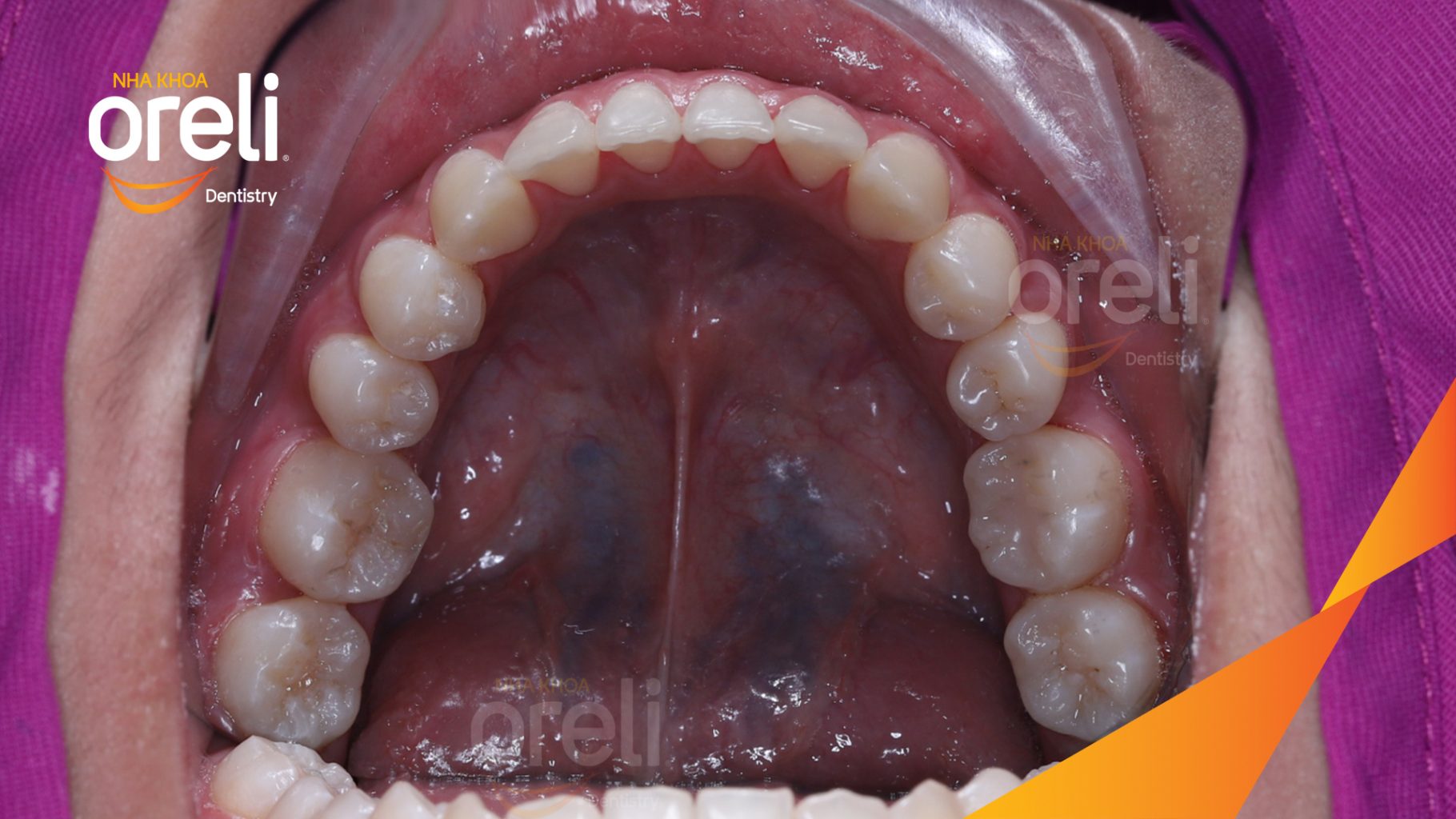 Thực hiện Niềng di gần răng 78 hàm dưới thay thế răng 6 mất kéo dài 2 năm tại Nha khoa Oreli