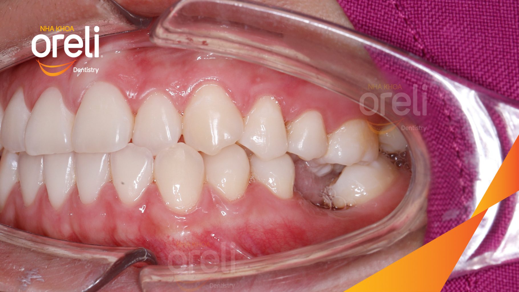 Kết quả sau 2 năm: Phục hồi mất răng bằng răng thật tại Nha khoa Oreli