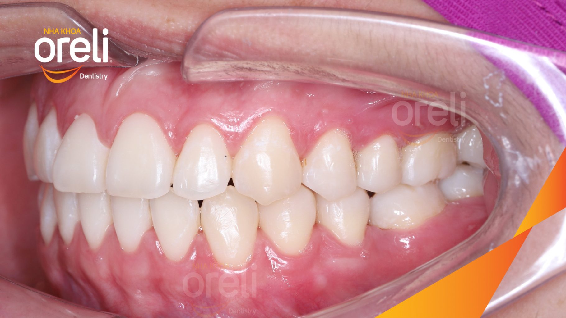 Kết quả đạt được sau 2 năm - Phục hồi mất răng bằng răng thật tại Nha khoa Oreli