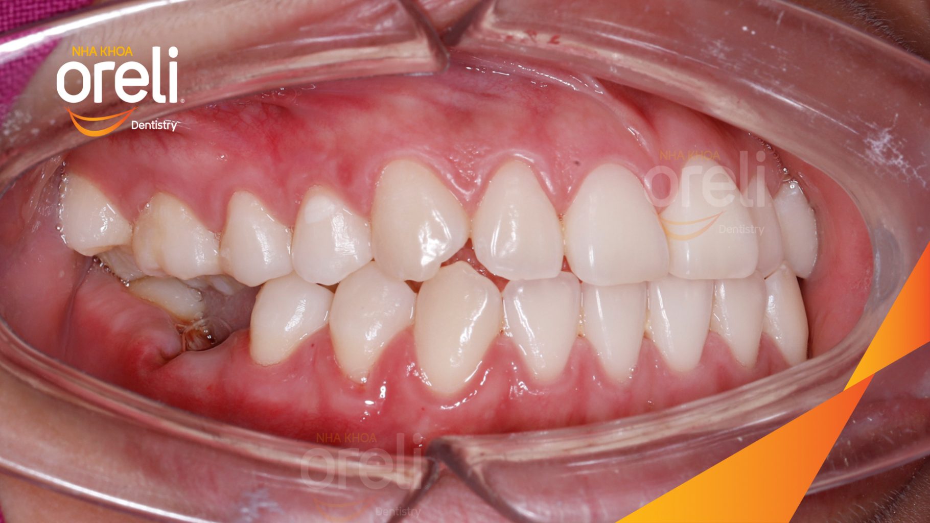 Trước điều trị: Mất răng 36 46 do sâu vỡ  tại Nha khoa Oreli