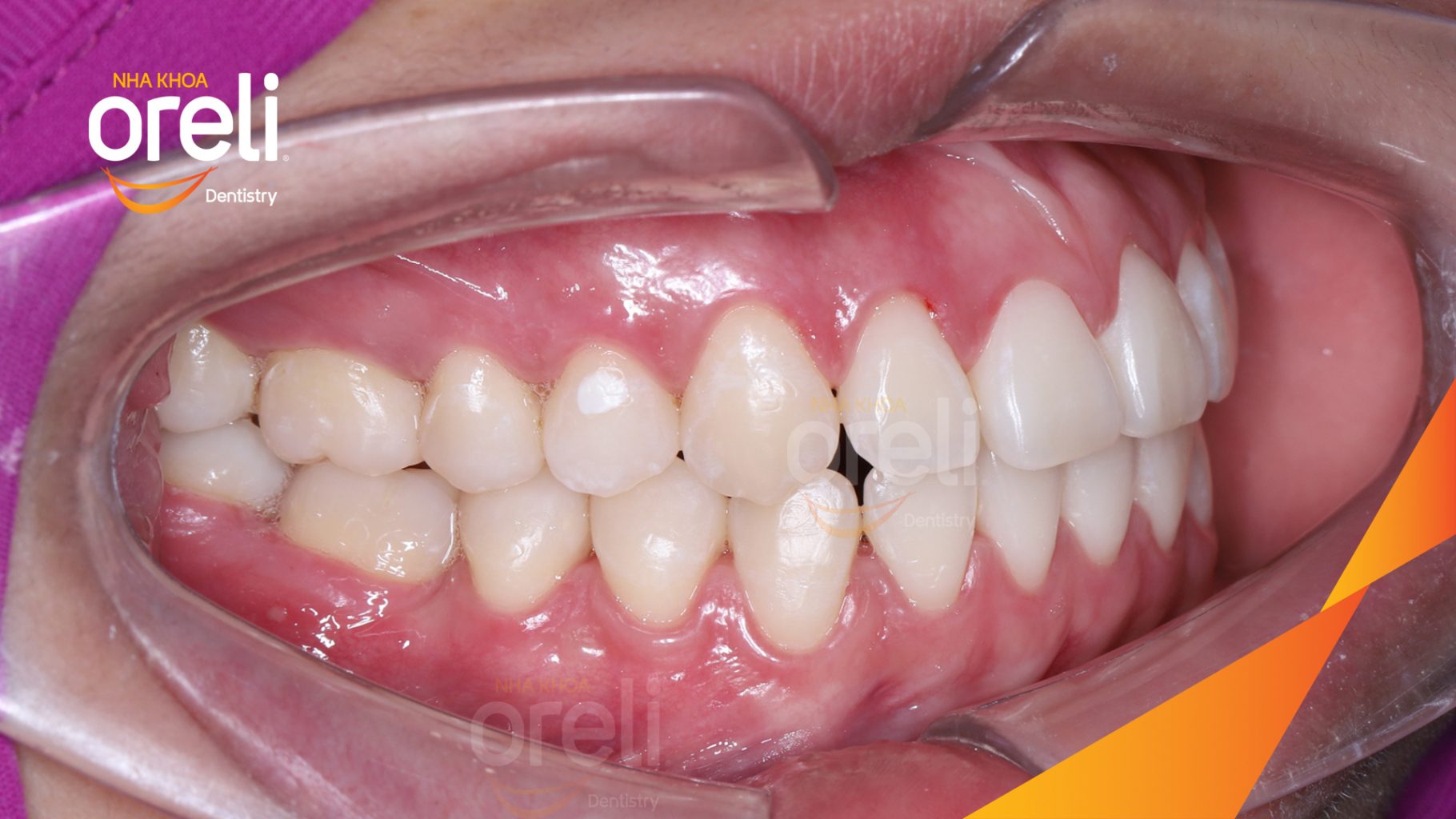 Mất răng 36 46 do sâu vỡ  trước khi điều trị tại Nha khoa Oreli