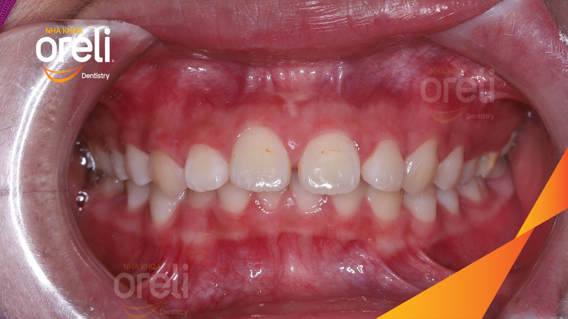 Trước điều trị: Sai khớp cắn hạng 2 cắn sâu hô hai hàm tại Nha khoa Oreli