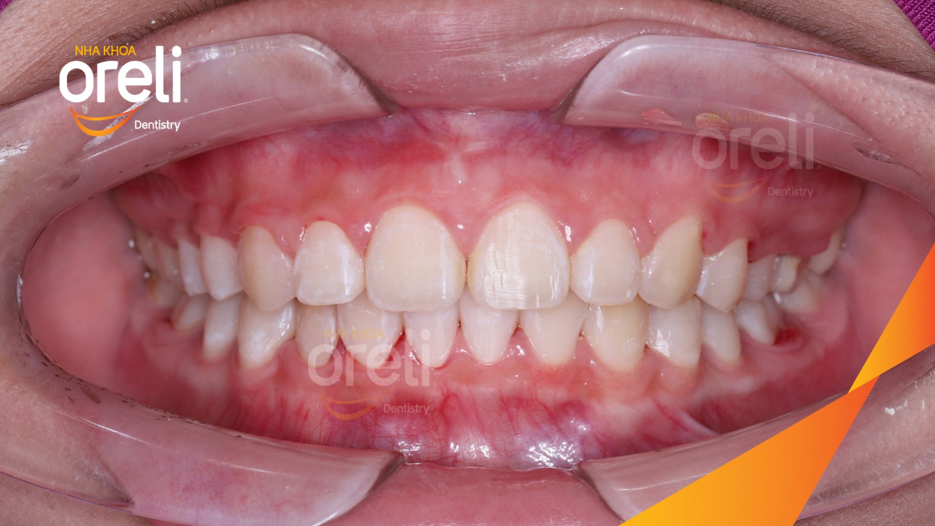 Sai khớp cắn hạng 2 cắn sâu hô hai hàm trước khi điều trị tại Nha khoa Oreli