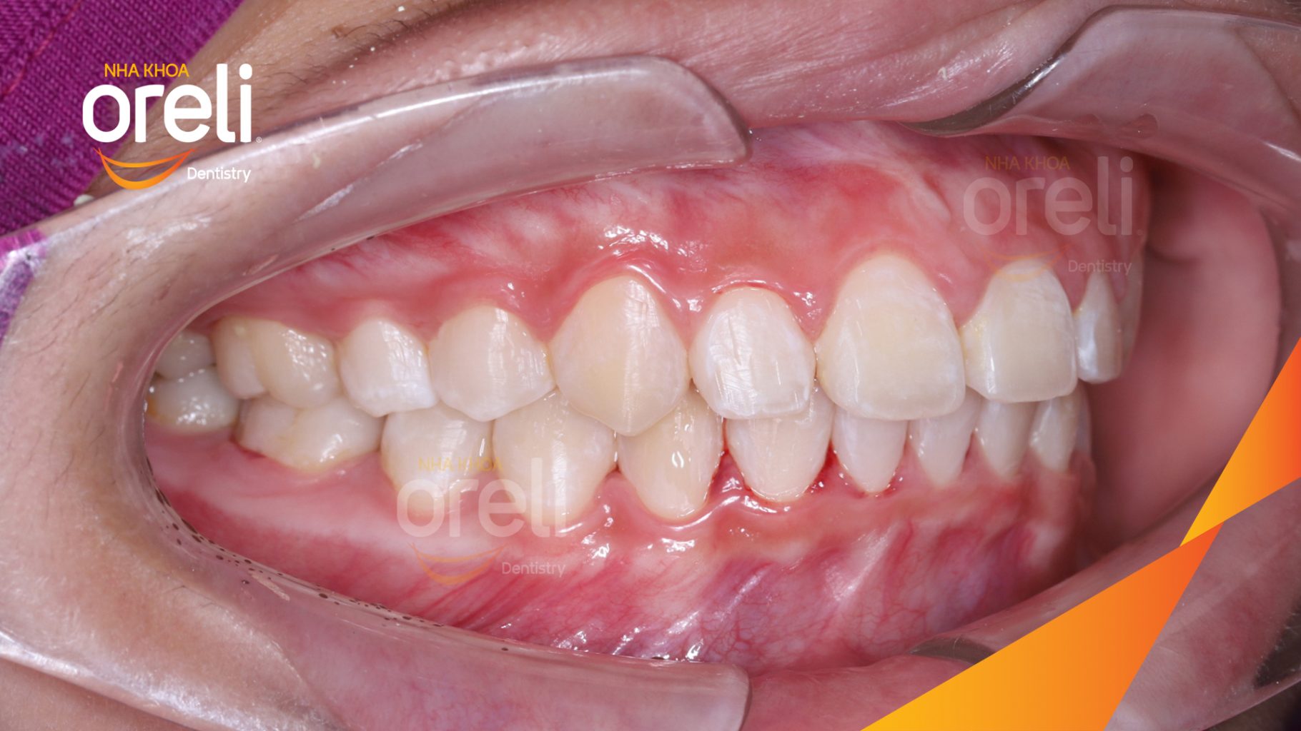 Thực hiện Niềng răng mở khớp cắn chỉnh cắn sâu và giảm độ nhô môi kéo dài 24 tháng tại Nha khoa Oreli